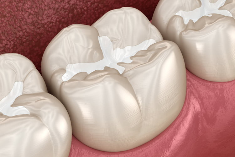 composite tooth fillings