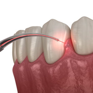 laser cosmetic procedure being performed on gums