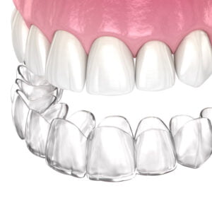 clear aligners used in orthodontics