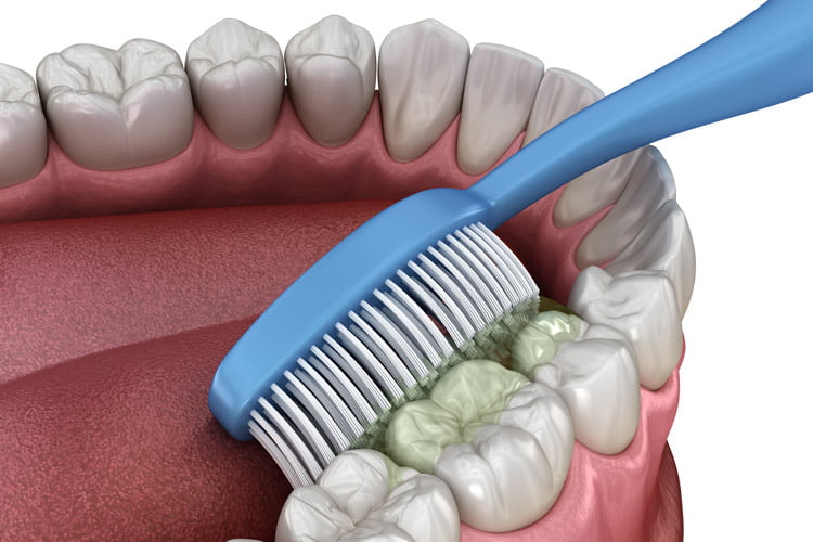 An example of dental cleaning in Madison, WI