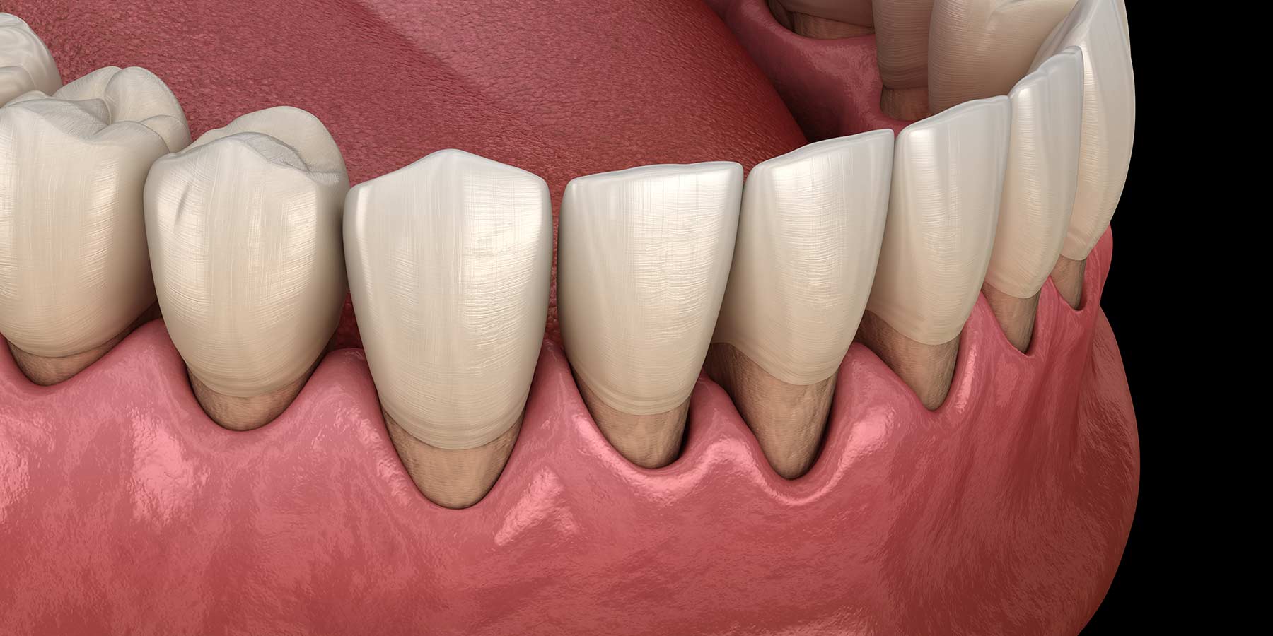 Gum Disease Causes & Treatment | Periodontal Disease Dentist