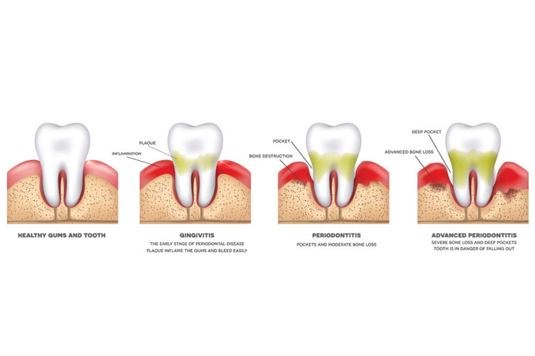 stages of periodontitis