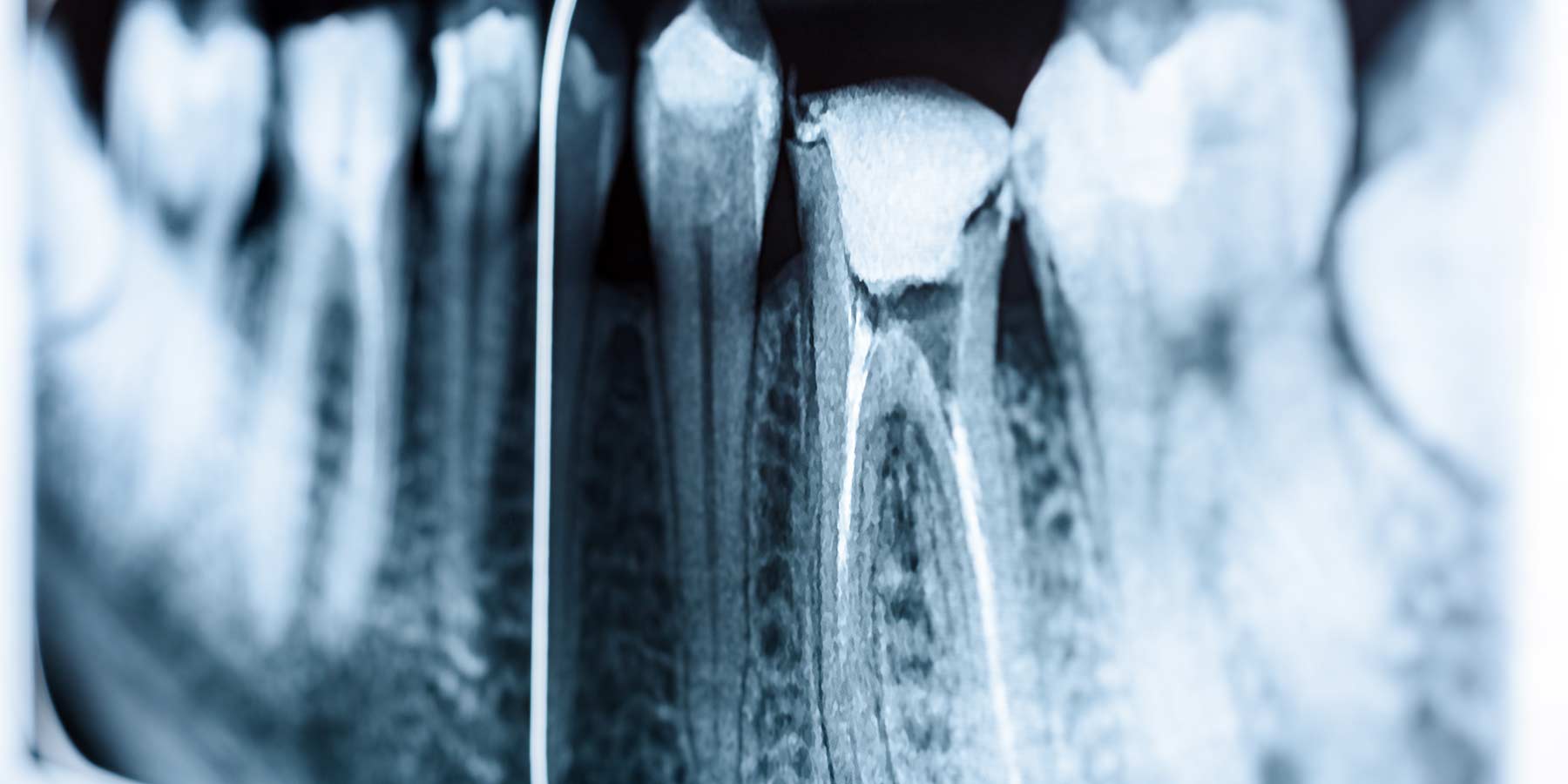 Root Canal Images