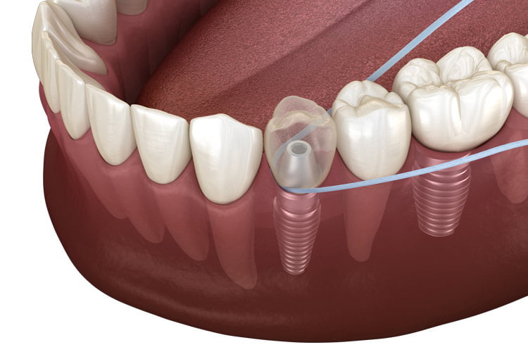 dental implant cleaning