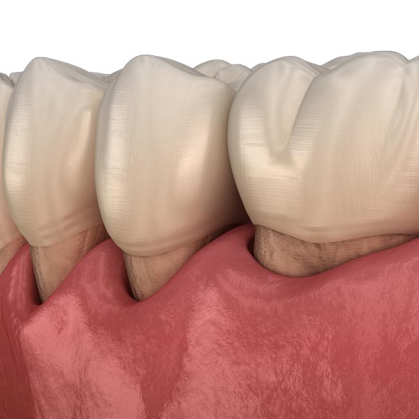 Periodontal Gum Disease, Gingivitis