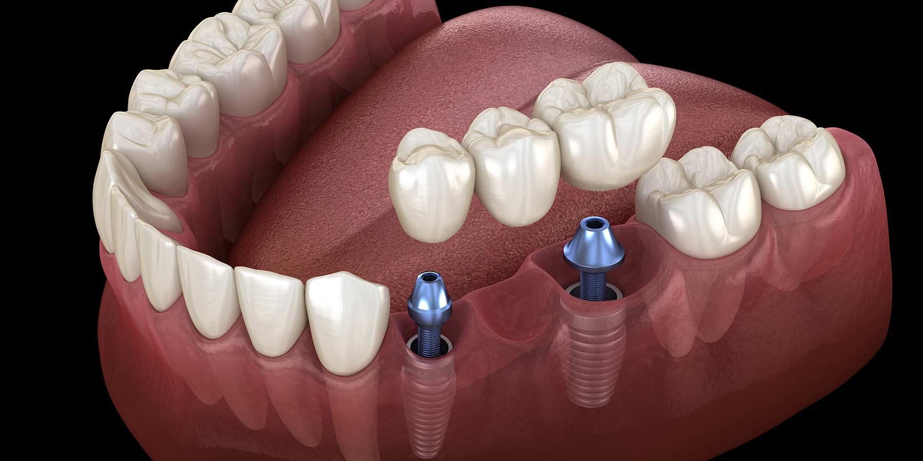 the Difference Between Dental Implants and Dental Bridges