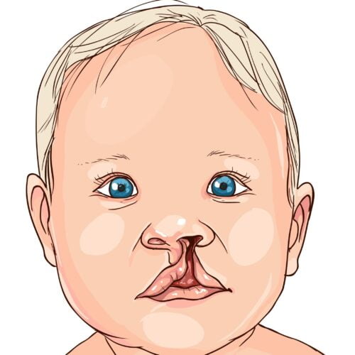 Cleft Palate Unilateral