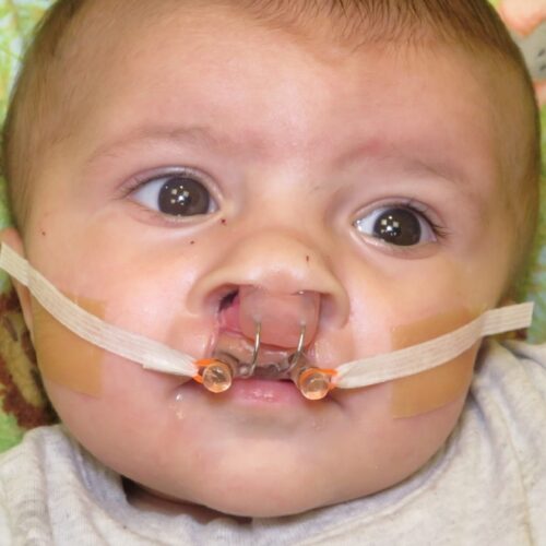 NAM Treatment for Cleft Lip