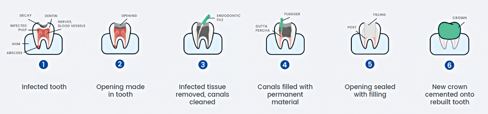 Root Canal Procedure Steps