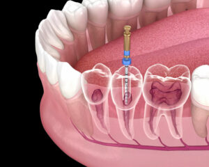 endodontic-root-canal-treatment-process-medically